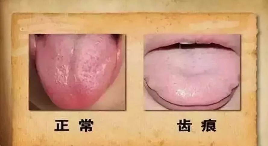 紫鑫名方中医团队建议: 日常发现舌苔白厚发白要关注脾胃健康和祛湿